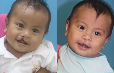 before and after image of surgery