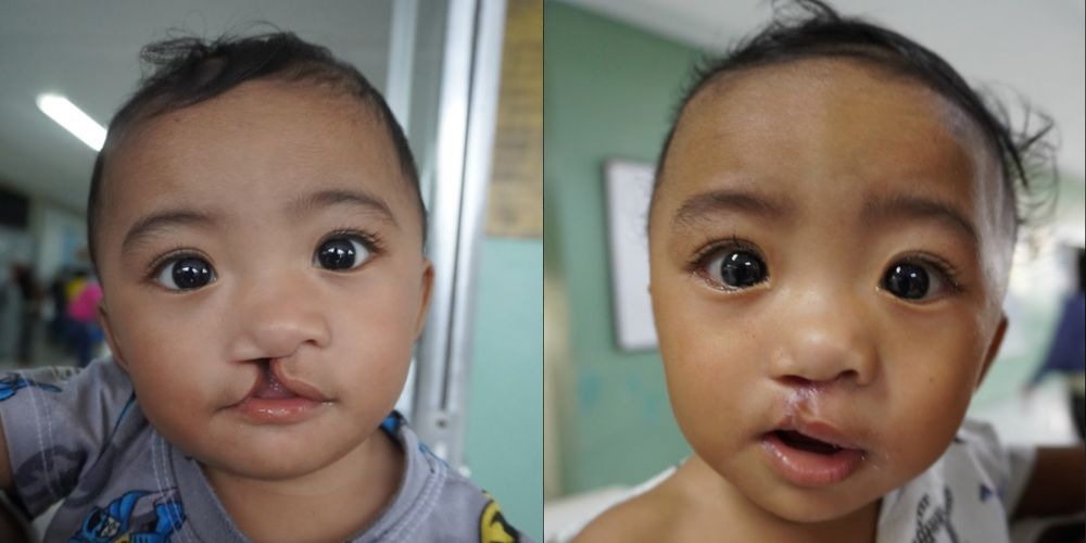 cleft lip surgery before and after
